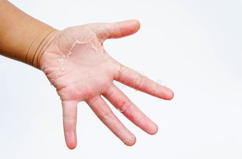 As mãos secas, casca, dermatite de contato, infecções fungosas, pele inf