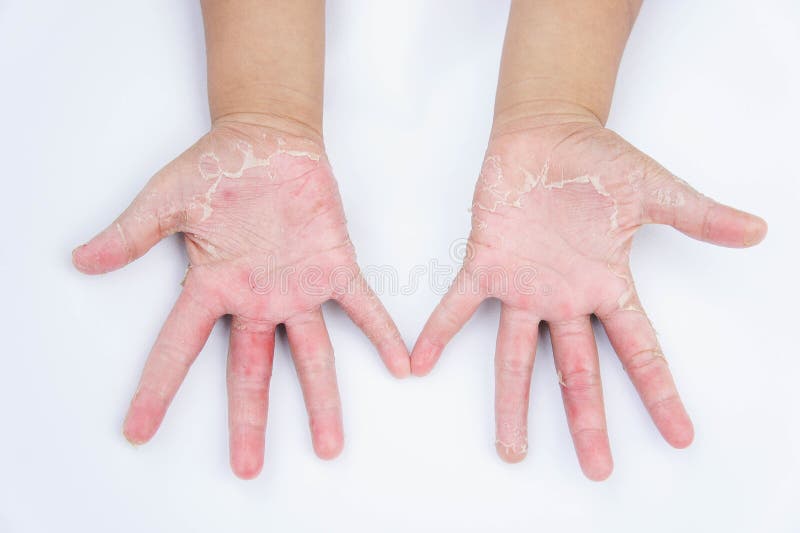 As mãos secas, casca, dermatite de contato, infecções fungosas, pele inf