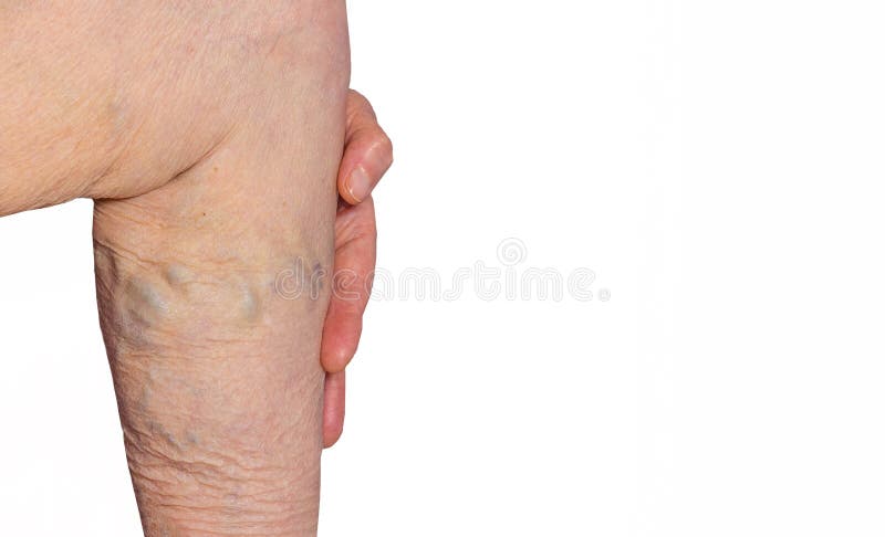 Varicoza picioare cauza, Perioada de reabilitare dupa operaie varicoza