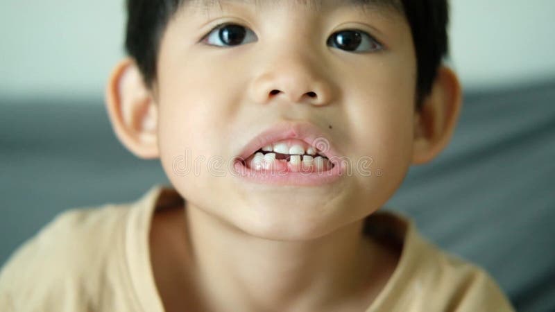 Asian boy opens his mouth to show his new teeth stock video