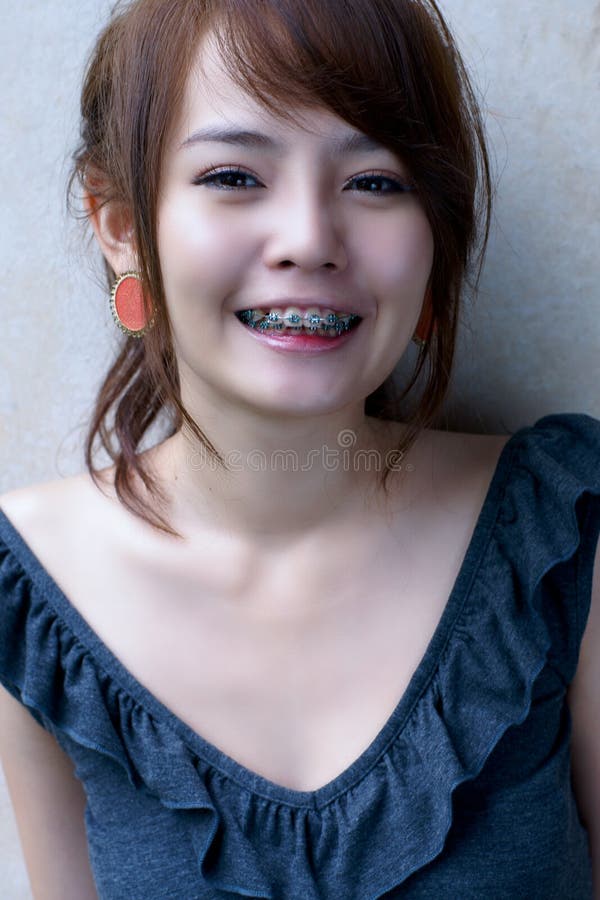 Braces More Teen Asian 113