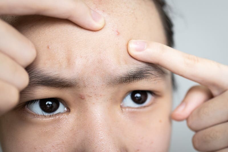 Asian Teen Girl Squeezing Pimples with Fingers on Her Forehead,popping a  Pimple on Face,a Plug of Sebum in a Hair Follicle Causes Stock Image -  Image of hormonal, face: 219944831