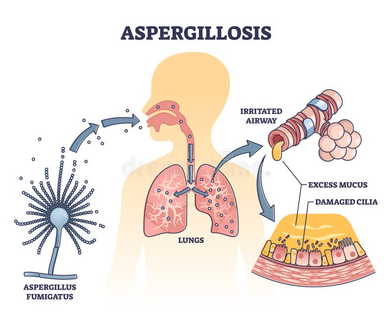Aspergillos lunginfektion orsakad av aspergillus vektordiagram vektor illustrationer