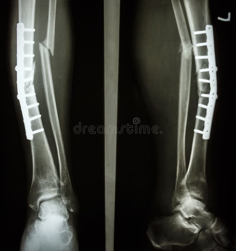 Frattura Scomposta Tibia E Perone Risarcimento Asse Di Frattura Della Tibia E Del Perone Immagine Stock - Immagine