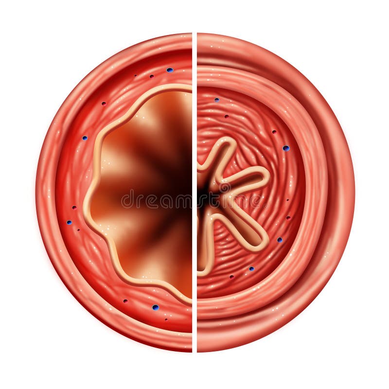 Asthma Bronchial Tube