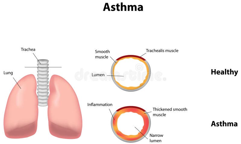 Asthma stock vector. Image of health, inhaler, lungs 