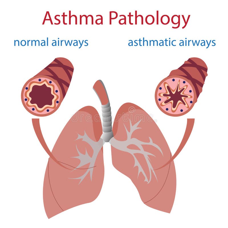 Vector illustration of lungs and airways. Normal and asthmatic. Vector illustration of lungs and airways. Normal and asthmatic.