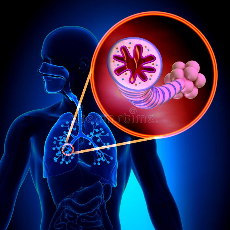 Asthme  Maladie Inflammatoire Chronique  Anatomie Illustration Stock