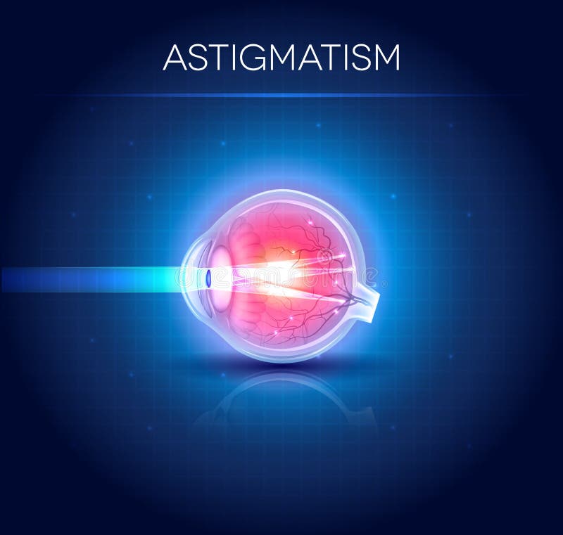 Astigmatism eyesight disorder