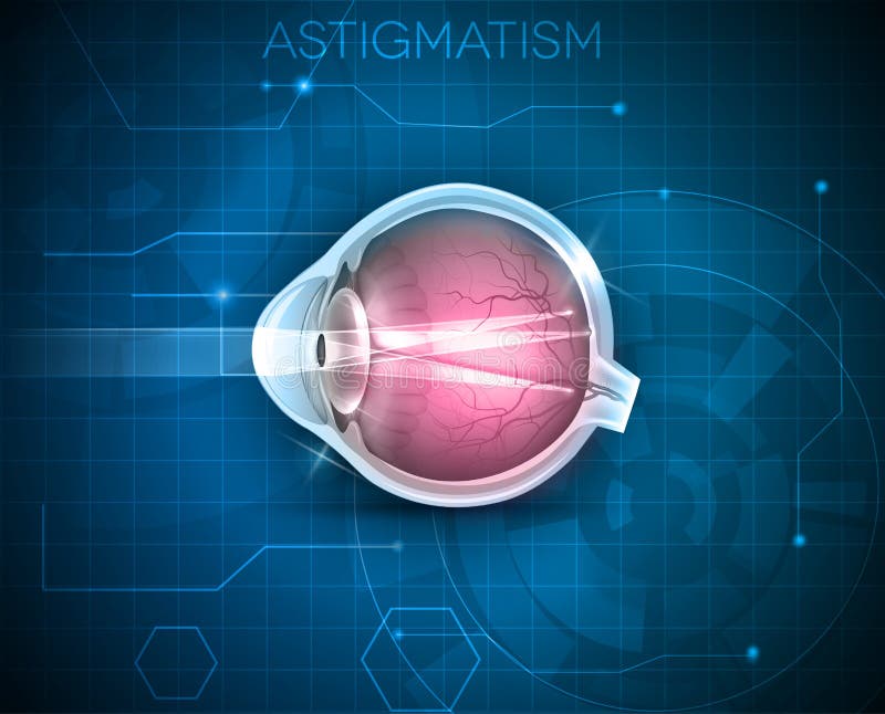 Astigmatism, eyesight problem