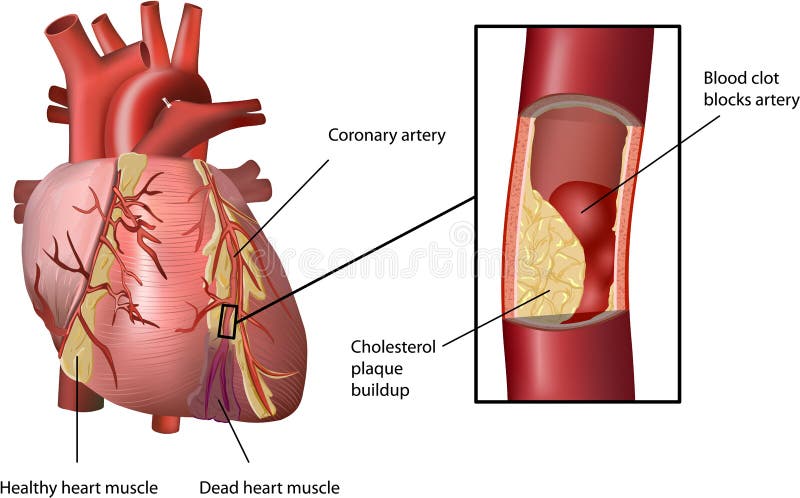 Atak powodować cholesterolu serce