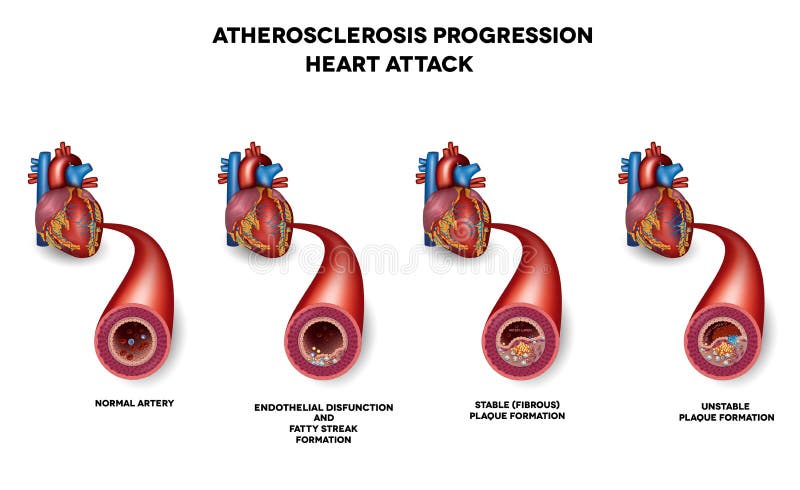 Atak serca, Wieńcowej arterii choroba