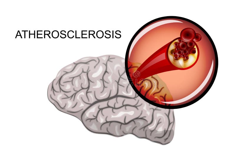 Ateroesclerosis de los buques del cerebro ilustración del vector Ateroesclerosis de los buques del cerebro ilustración del vector