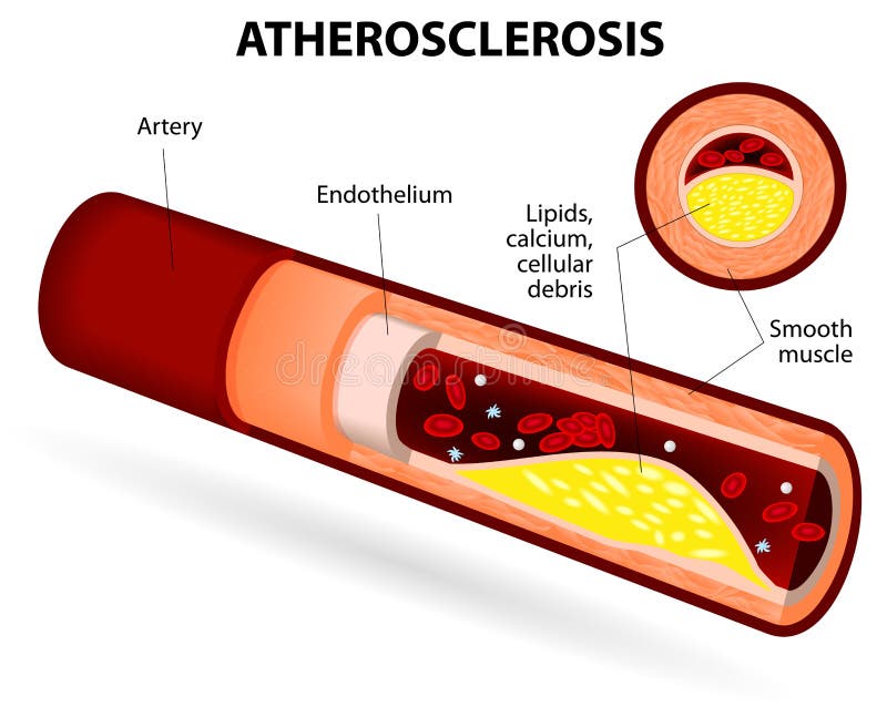 Ateroskleróza.