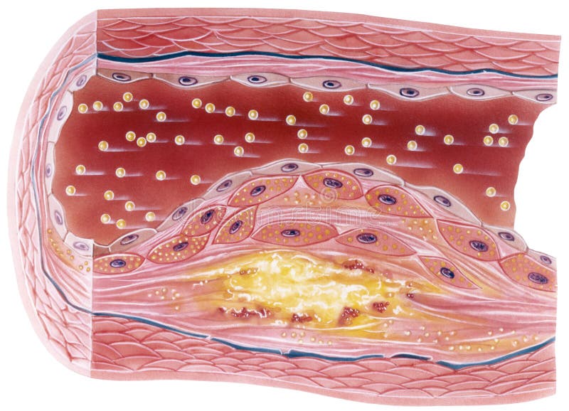 Vascular atherosclerosis showing a cutaway view of accumulated plaque in an afflicted blood vessel. Vascular atherosclerosis showing a cutaway view of accumulated plaque in an afflicted blood vessel.