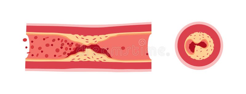 Тромб и бляшка разница. Атеросклеротическая бляшка на белом фоне. Атеросклероз иллюстрация. Атеросклероз иконка.