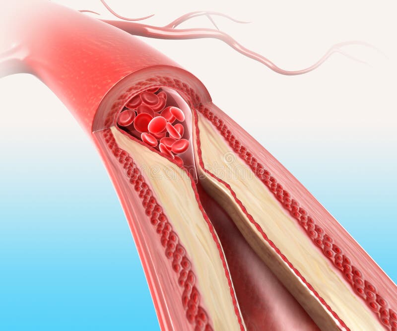 Athersclerosis w arterii