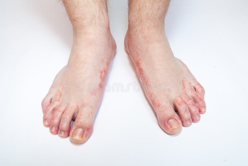 Athlete s foot fungi stock photo. Image of sore, fungus 71740552