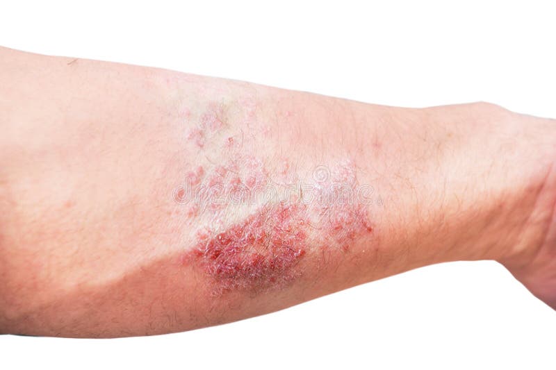 dermatitis i zglobovima