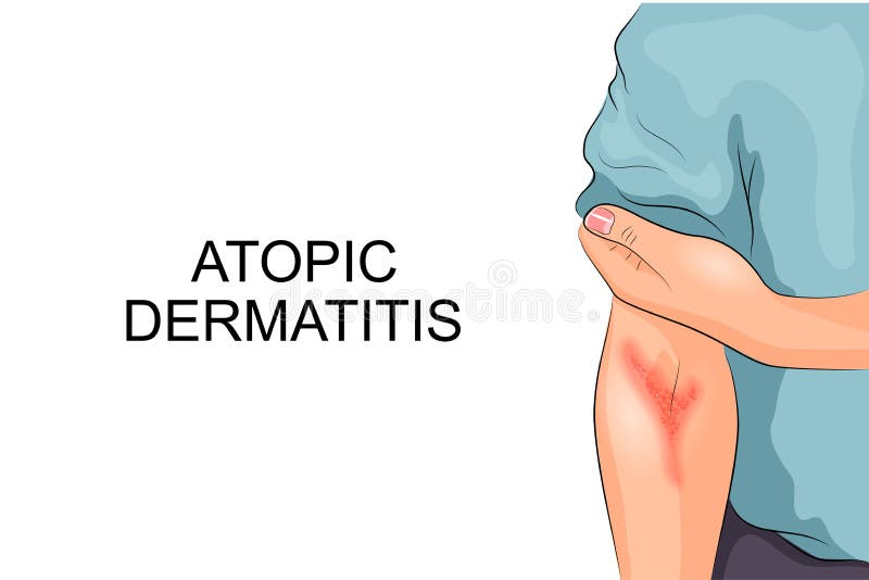 Atopic dermatitis. Allergy
