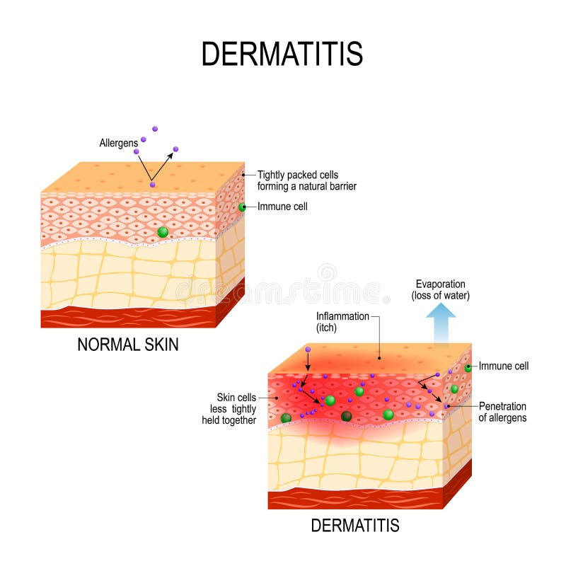 Atopic dermatitiseczema vector illustratie Atopic dermatitiseczema vector illustratie