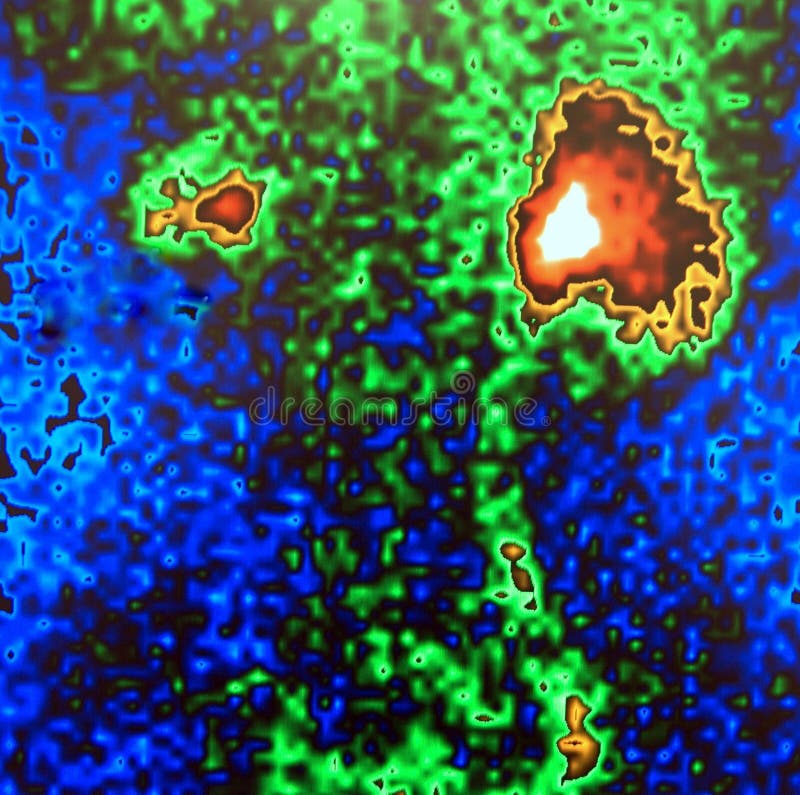 Atrophic kidney nuclear scan stock photography