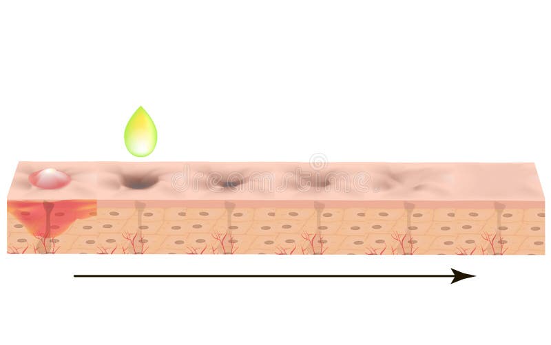 Atrophic scars. Acne scar. The anatomical structure of the skin with acne. Vector illustration on isolated background.