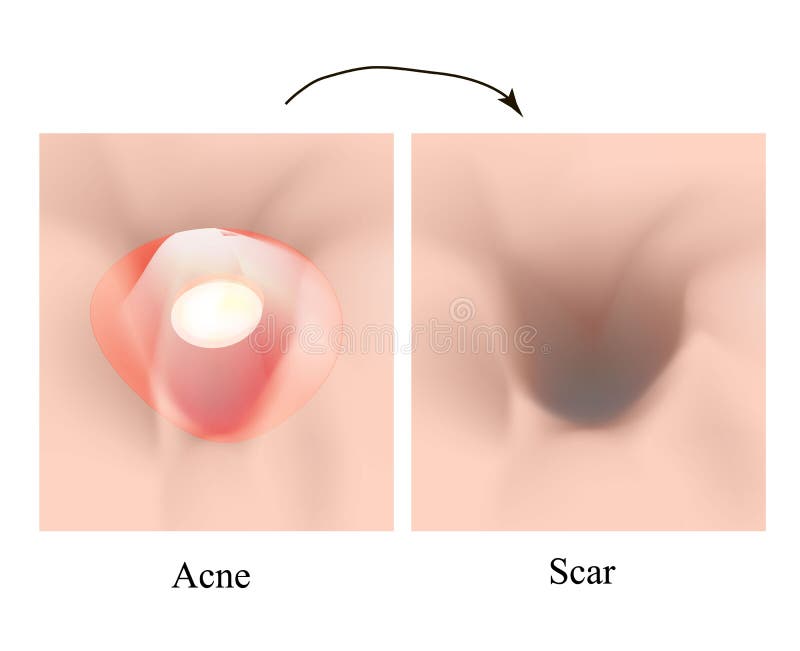 Atrophic scars. Acne scar. The anatomical structure of the skin with acne. Vector illustration on isolated background.