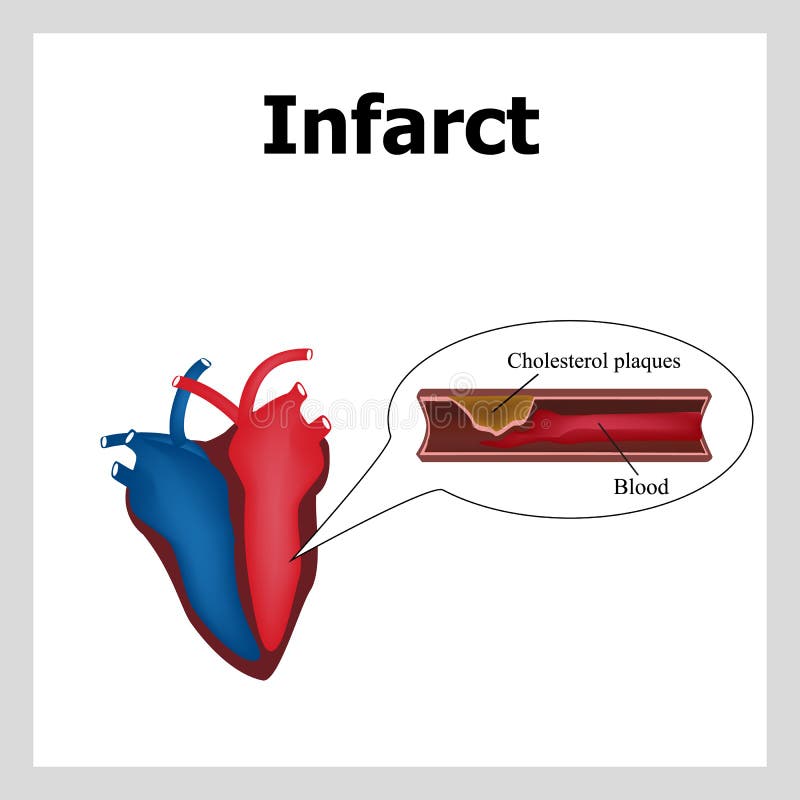 attack heart keeps man _ thrombus Αρτηρία-απόφραξη της χοληστερόλης Πινακίδες χοληστερόλης Infographics διάνυσμα ελεύθερη απεικόνιση δικαιώματος attack heart keeps man _ thrombus Αρτηρία-απόφραξη της χοληστερόλης Πινακίδες χοληστερόλης Infographics διάνυσμα ελεύθερη απεικόνιση δικαιώματος