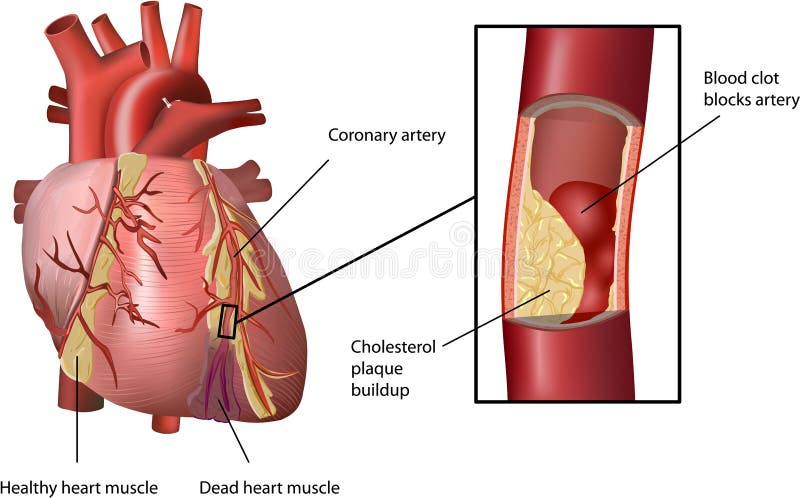 Human Heart Coronary Problem. Cholesterol plaque built up in artery (atherosclerosis). Vector Illustration with annotation isolated on white background. Human Heart Coronary Problem. Cholesterol plaque built up in artery (atherosclerosis). Vector Illustration with annotation isolated on white background.