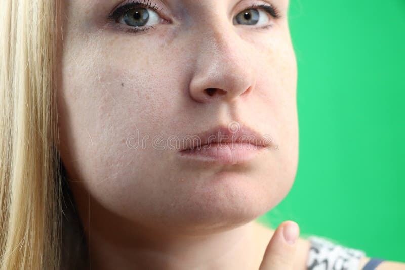 Swollen Cheek Photos - Free & Royalty-Free Stock Photos from Dreamstime Swollen Cheek Photos - Free & Royalty-Free Stock Photos from Dreamstime
