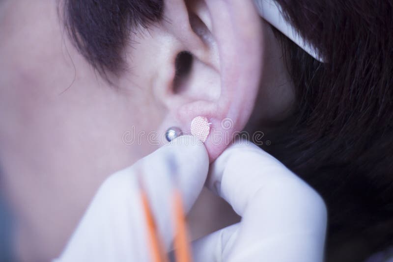 Auriculartherapy orientální acupunture ucho semen nálepka omítky auriculatherapy léčby fyzioterapie.