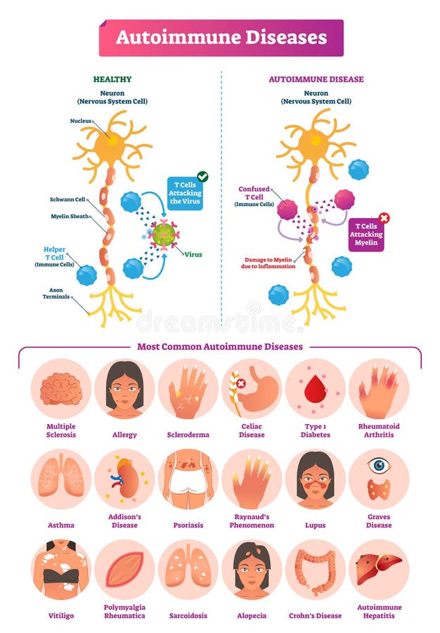 Auto-immune ziekten vectorillustratie Diverse reeks van de ziekteinzameling