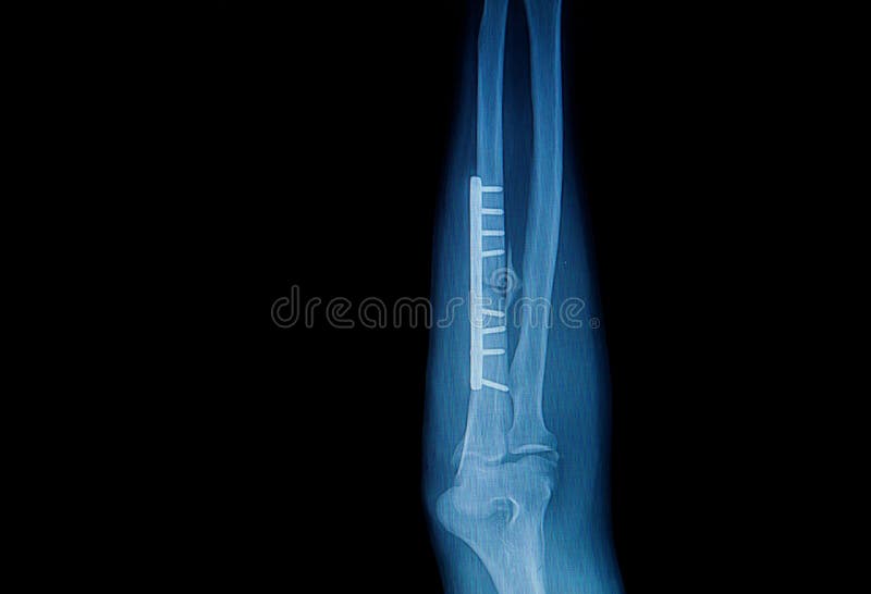 Le Coude De Fracture, Avantbras Radiographie L'image Photo stock