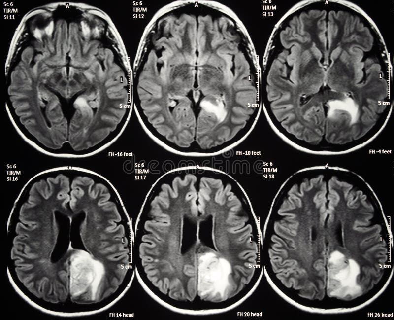 Axial cut of brain MRI displaying a left parietal tumor. This tumor is malignant and it is called glioblastoma. It requires surgery, radiation therapy and chemotherapy for its treatment. Axial cut of brain MRI displaying a left parietal tumor. This tumor is malignant and it is called glioblastoma. It requires surgery, radiation therapy and chemotherapy for its treatment.