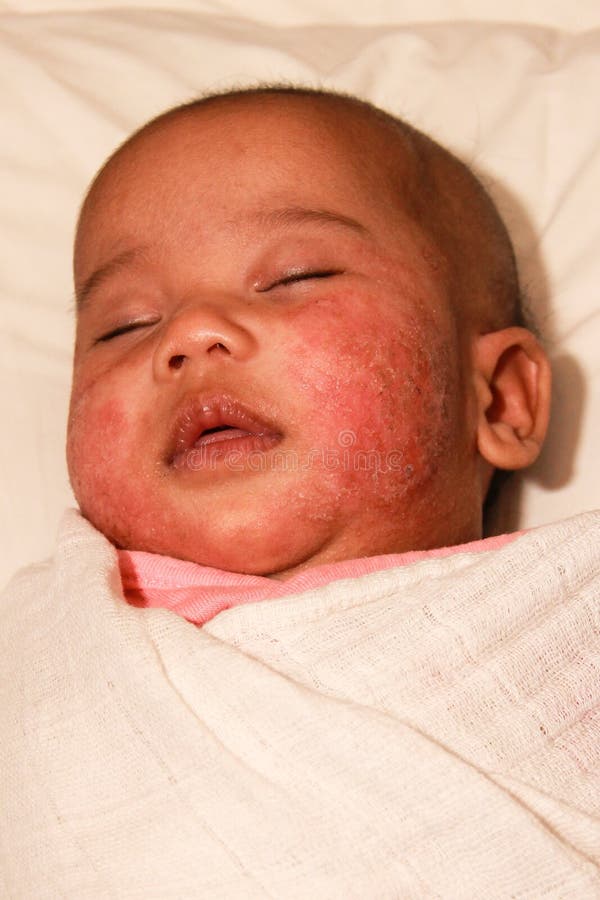 Baby with atopic dermatitis