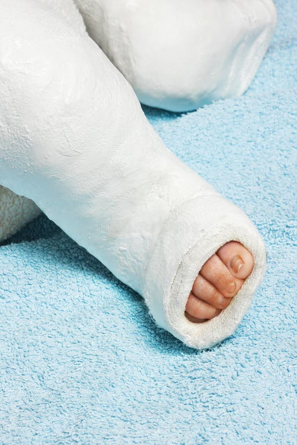 Baby Boy S Leg with Plaster Bandage Stock Photo Image of little