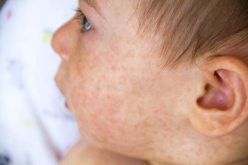 Baby met dermatitisprobleem van uitbarsting Allergie die aan voedselallergieën lijden Close-up atopic symptoom op huidwangen Conc stock foto Baby met dermatitisprobleem van uitbarsting Allergie die aan voedselallergieën lijden Close-up atopic symptoom op huidwangen Conc stock foto