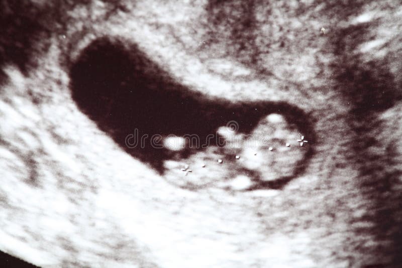 Baby ultrasound