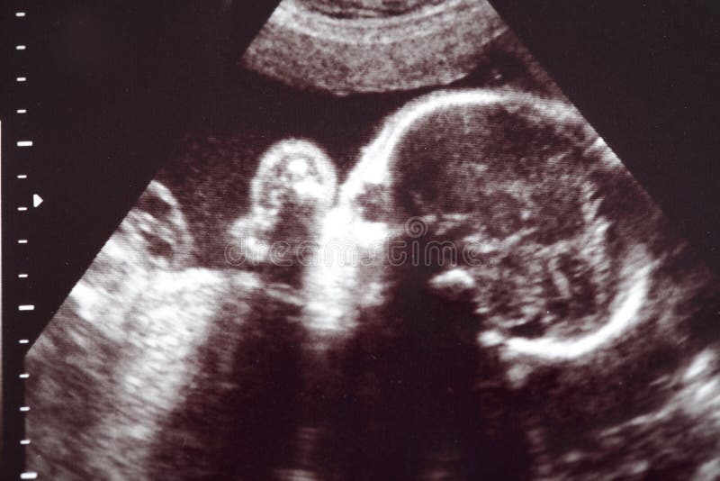 Baby ultrasound