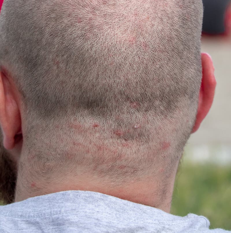Back of the Head of a Short Haired Man Suffering from Scalp Acne Problem Stock Image - Image of allergy, hormone: 185663817 Back of the Head of a Short Haired Man Suffering from Scalp Acne Problem Stock Image - Image of allergy, hormone: 185663817