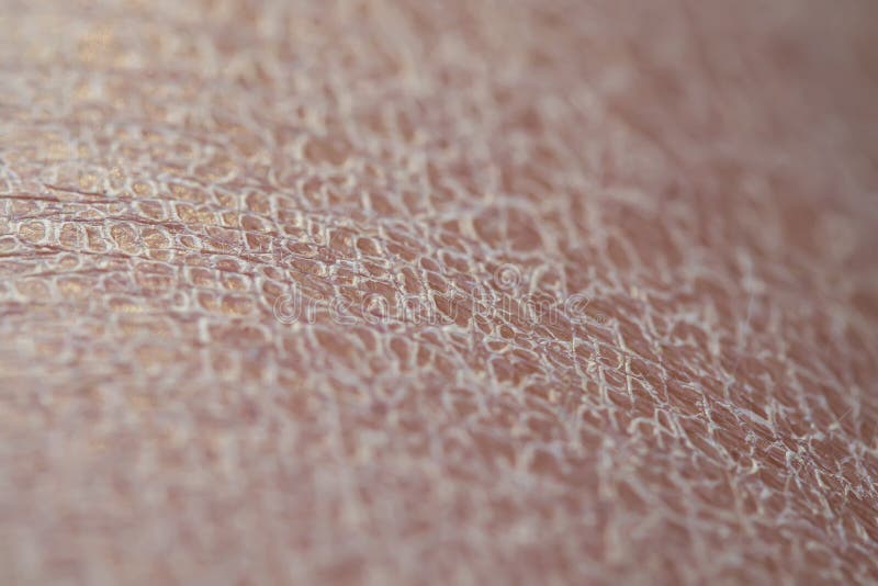 Dry skin stock image. Image of hospital, lesion, eczema 