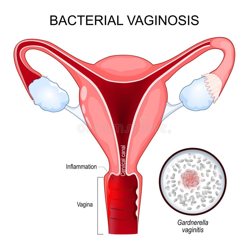 Gardnerella Vagina