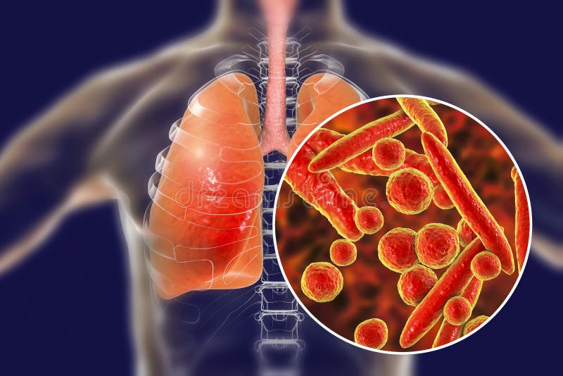 Bactéries de pneumoniae de mycoplasma dans des poumons humains illustration stock Bactéries de pneumoniae de mycoplasma dans des poumons humains illustration stock