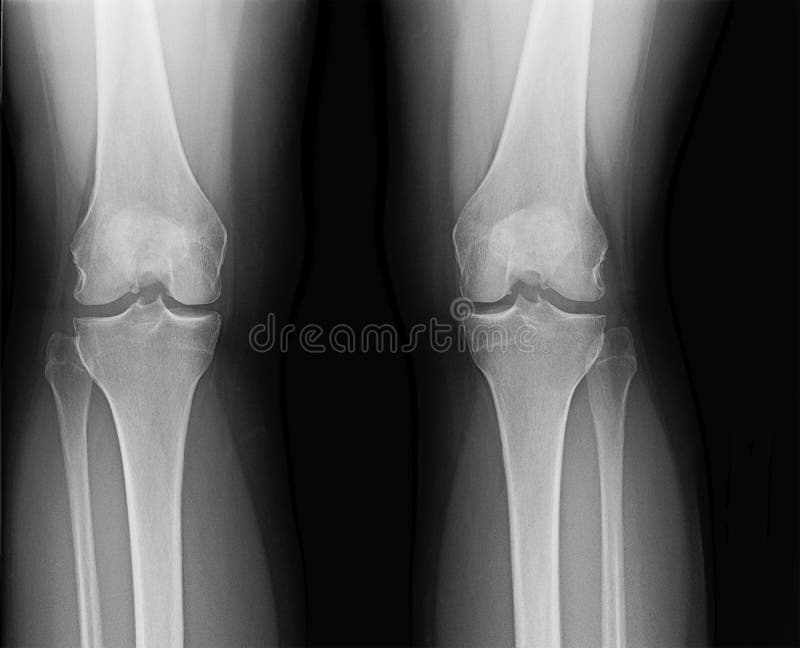 X-ray of knees of mature female suffering from minor osteoarthritis and bone spurs. X-ray of knees of mature female suffering from minor osteoarthritis and bone spurs.