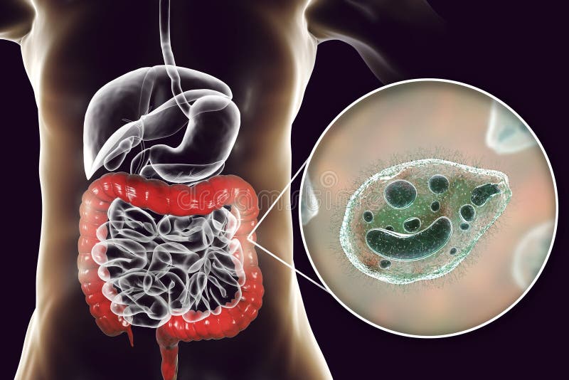 Sobrecrecimiento bacteriano intestinal