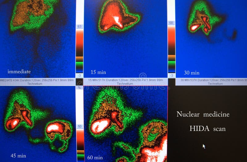 Nuclear medicine hida scan for gallbladder function examination with isotope ,every phase of study has mark as immediate after injection,15,30,45,and 60 minutes,there is normal function study. Nuclear medicine hida scan for gallbladder function examination with isotope ,every phase of study has mark as immediate after injection,15,30,45,and 60 minutes,there is normal function study