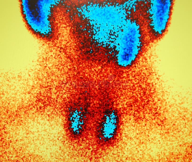 Parathyroid nuclear scan ,area of neck and chest of patient. Parathyroid nuclear scan ,area of neck and chest of patient