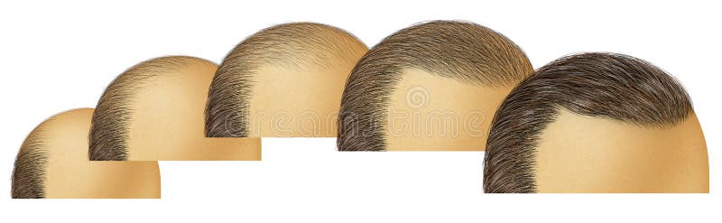 Hair Growth Stock Illustrations – 8,903 Hair Growth Stock Illustrations, Vectors & Clipart - Dreamstime Hair Growth Stock Illustrations – 8,903 Hair Growth Stock Illustrations, Vectors & Clipart - Dreamstime