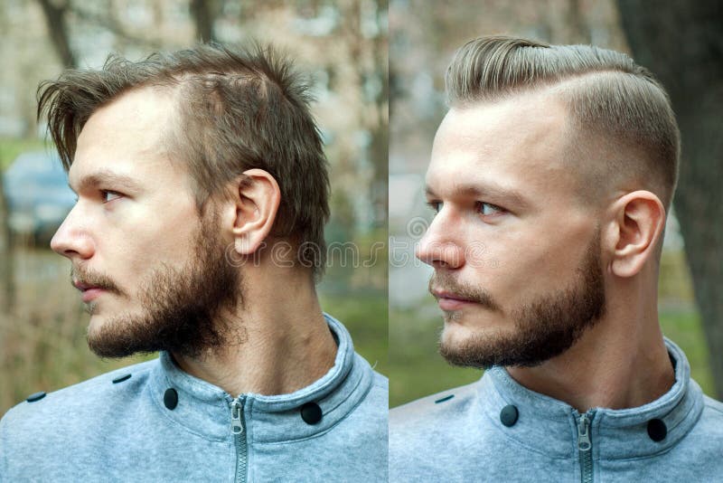 Bald Man before after Haircut Concept for a Barber Shop: Problem Man of Hair  Loss, Alopecia, Transplantation, Profile Stock Image - Image of  hairdresser, care: 185388173